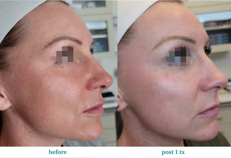 Renual Medspa opus before and after