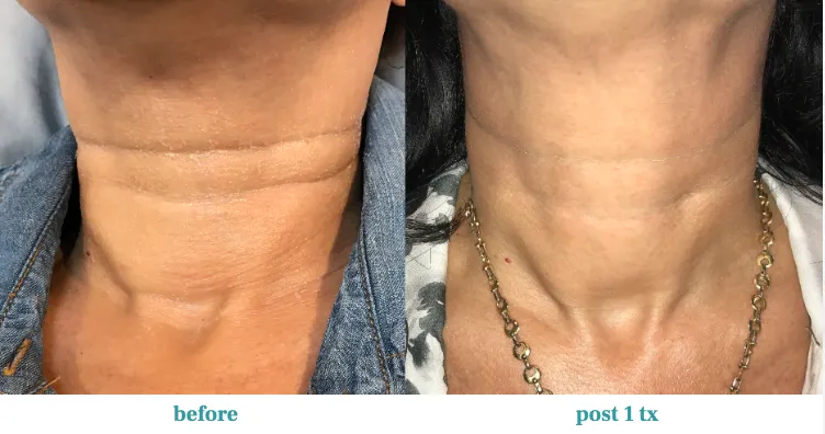 Renual Medspa opus before and after