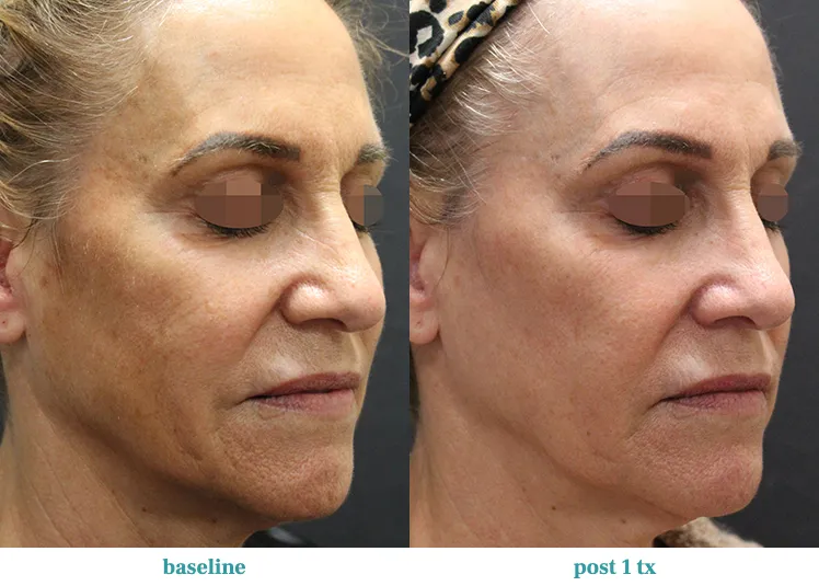Renual Medspa opus before and after