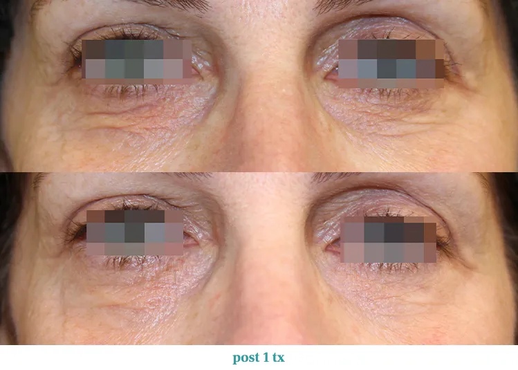 Renual Medspa opus before and after