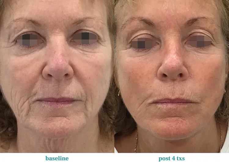 Renual Medspa opus before and after