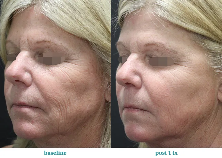 Renual Medspa opus before and after