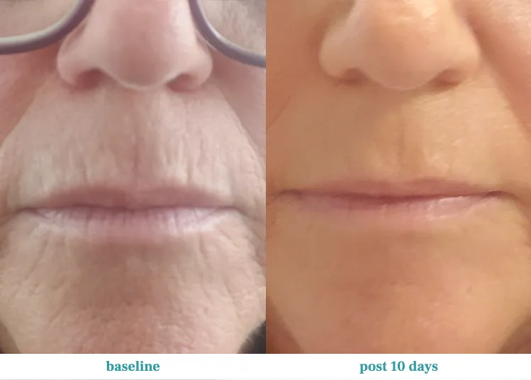 Renual Medspa opus before and after