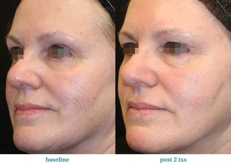 Renual Medspa opus before and after