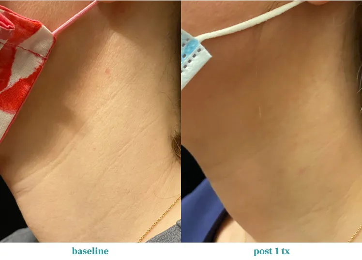 Renual Medspa opus before and after