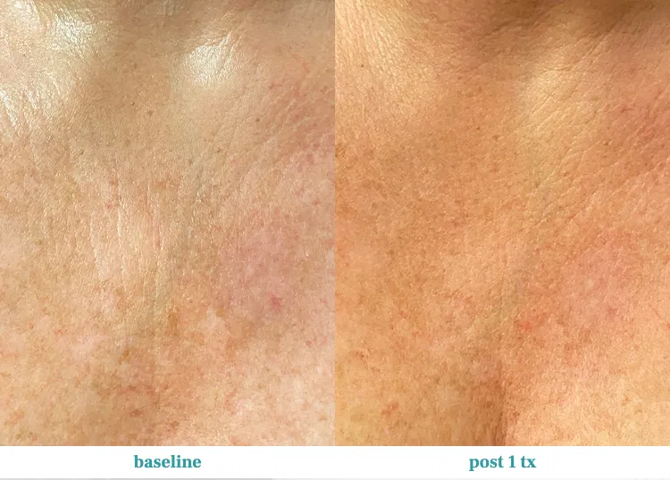 Renual Medspa opus before and after