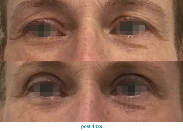 Renual Medspa opus before and after