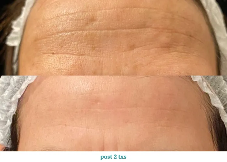 Renual Medspa opus before and after