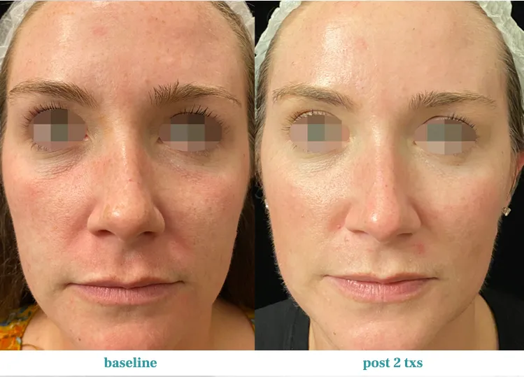 Renual Medspa opus before and after