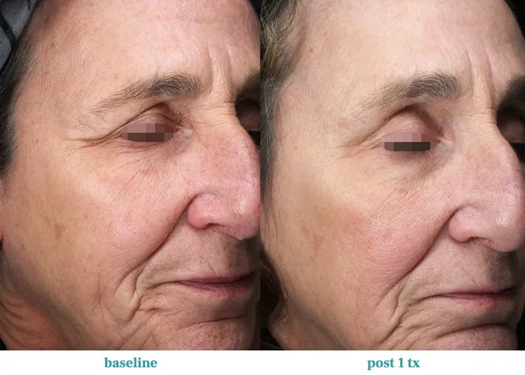 Renual Medspa opus before and after