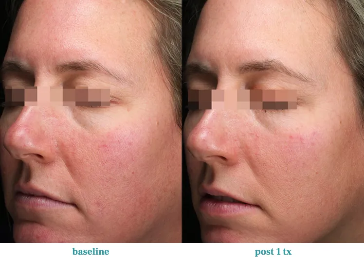 Renual Medspa opus before and after