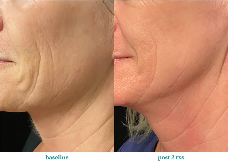 Renual Medspa opus before and after