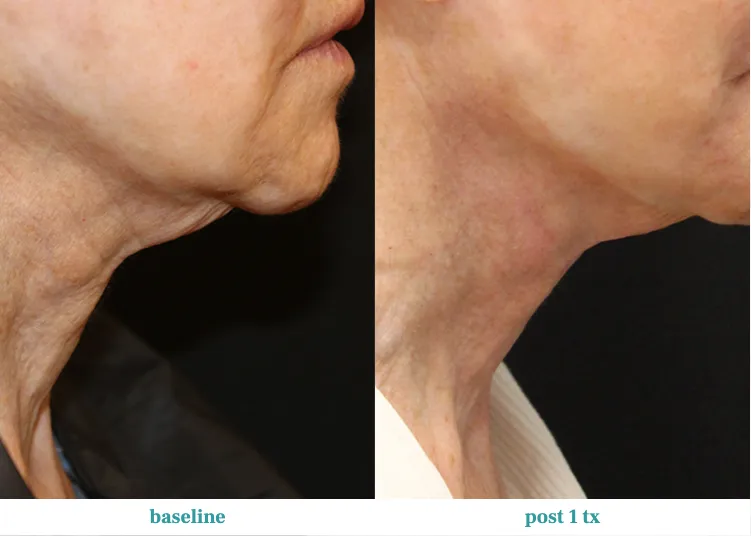 Renual Medspa opus before and after