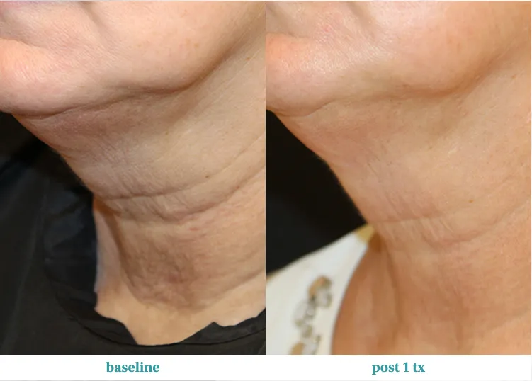 Renual Medspa opus before and after