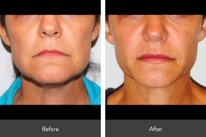 Renual Medspa morpheus8 before and after