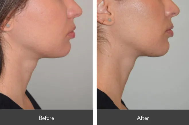 Renual Medspa morpheus8 before and after