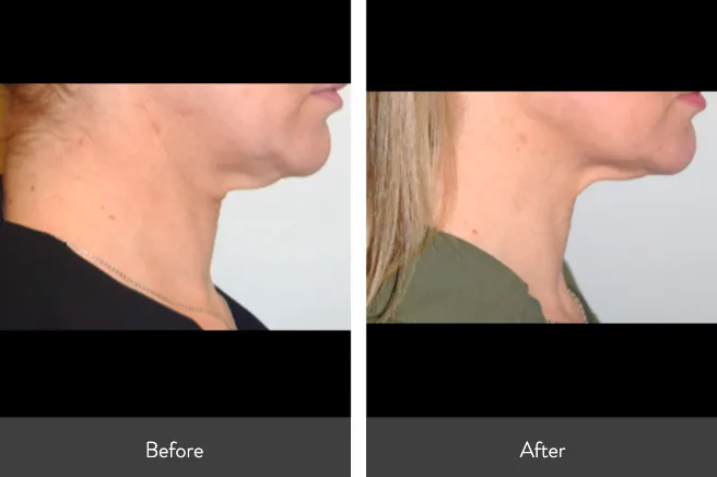 Renual Medspa morpheus8 before and after