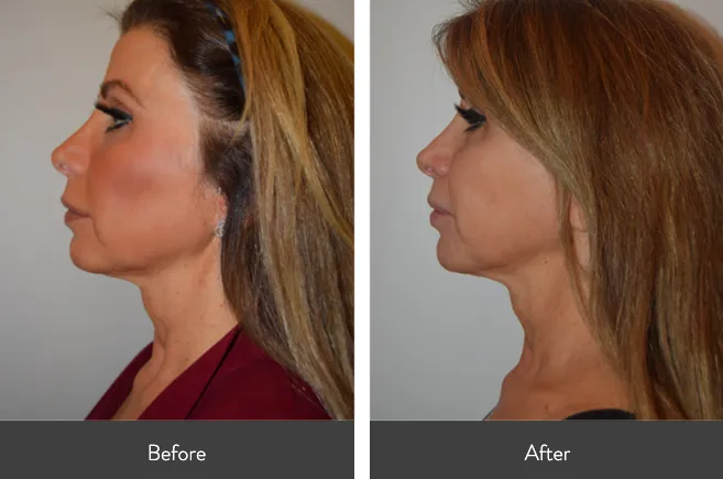 Renual Medspa morpheus8 before and after