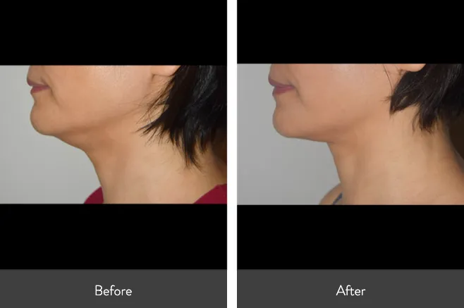 Renual Medspa morpheus8 before and after