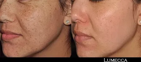 Renual Medspa lumecca before and after