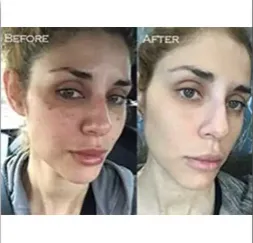Renual Medspa lumecca before and after