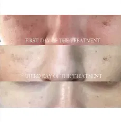 Renual Medspa lumecca before and after