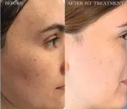 Renual Medspa lumecca before and after