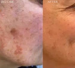 Renual Medspa lumecca before and after