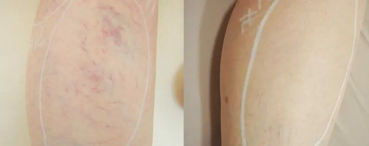 Renual Medspa vasculaze before and after