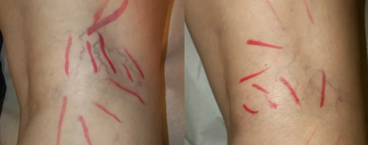 Renual Medspa vasculaze before and after