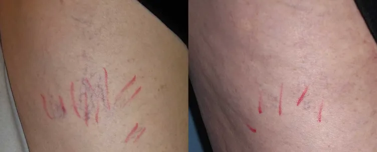Renual Medspa vasculaze before and after