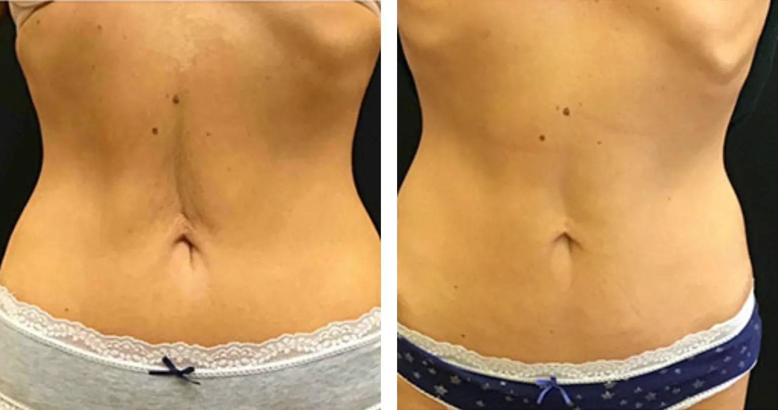 Renual Medspa bodyfx before and after