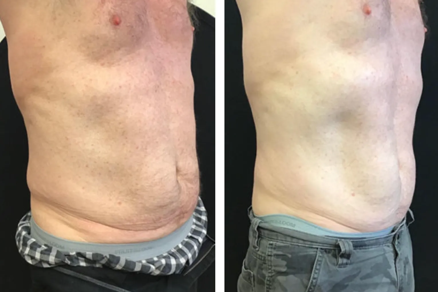 Renual Medspa bodyfx before and after