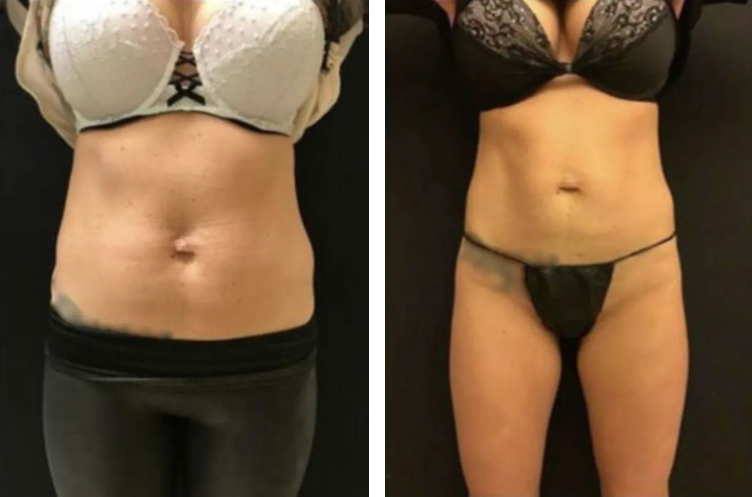 Renual Medspa bodyfx before and after