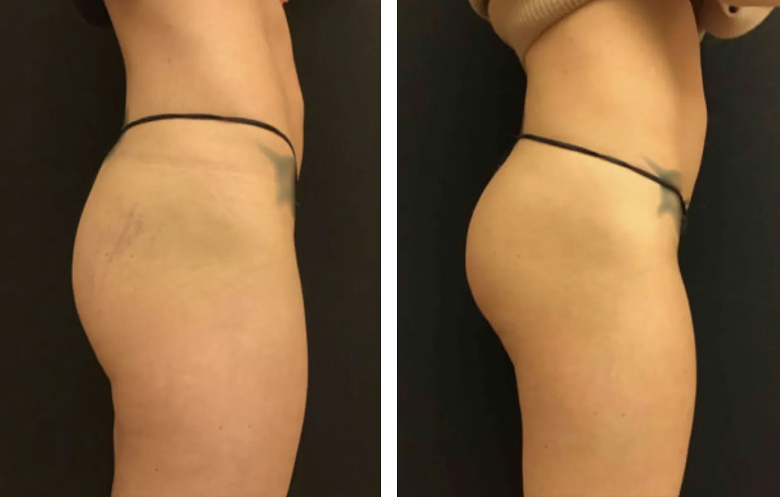 Renual Medspa bodyfx before and after