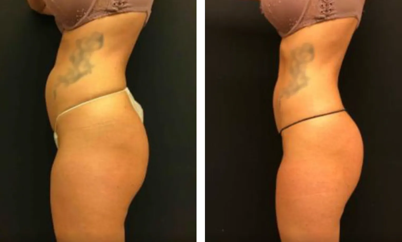 Renual Medspa bodyfx before and after