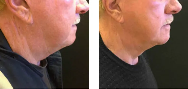 Renual Medspa minifx before and after
