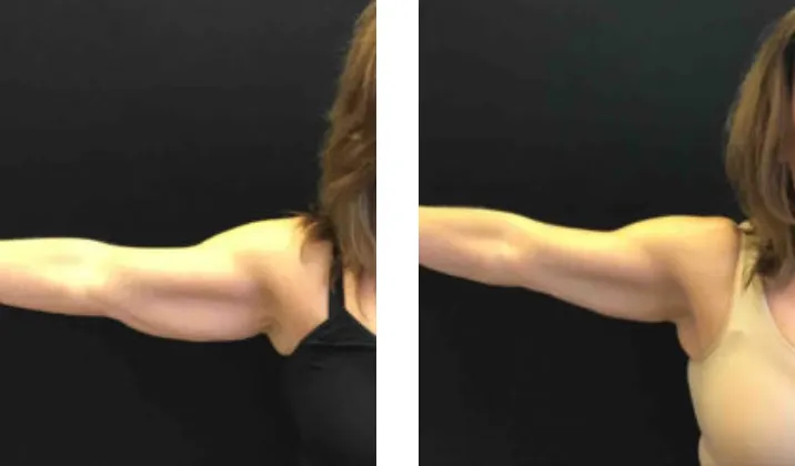 Renual Medspa minifx before and after