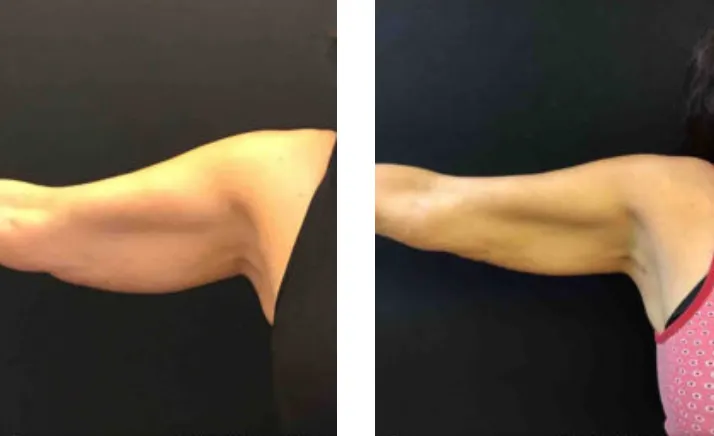 Renual Medspa minifx before and after