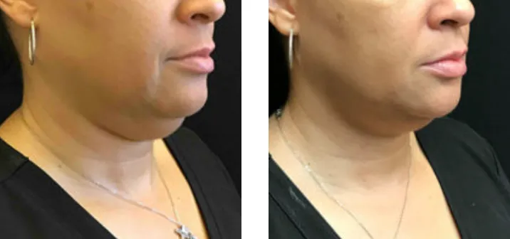 Renual Medspa minifx before and after