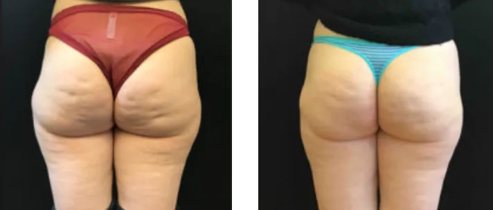 Renual Medspa minifx before and after