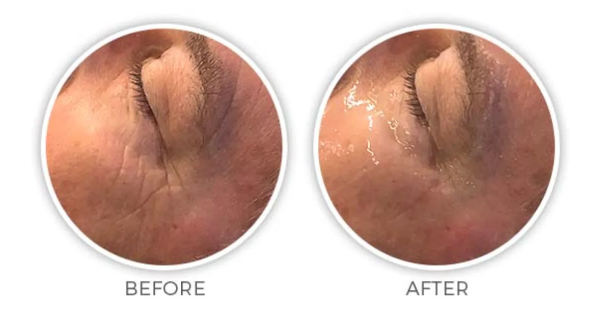 Renual Medspa cryotouch before and after