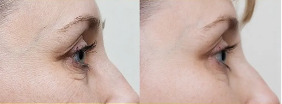 Renual Medspa cryotouch before and after
