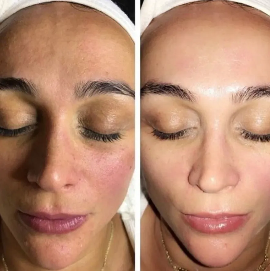 Renual Medspa cryotouch before and after