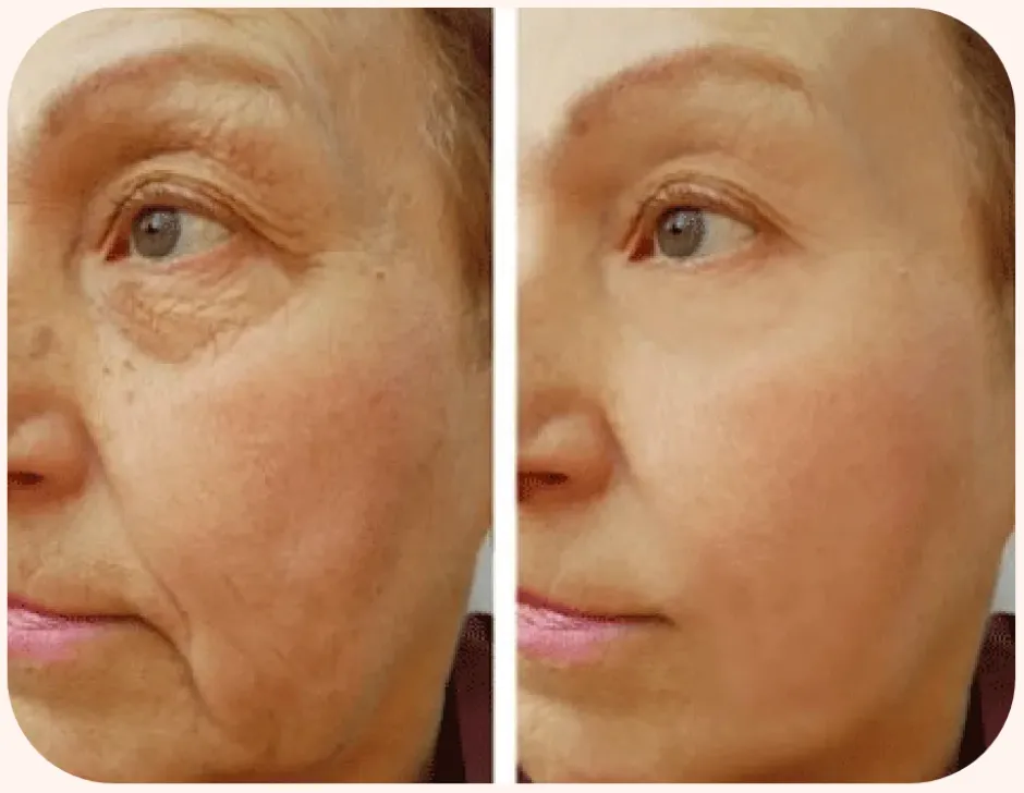 Renual Medspa cryotouch before and after