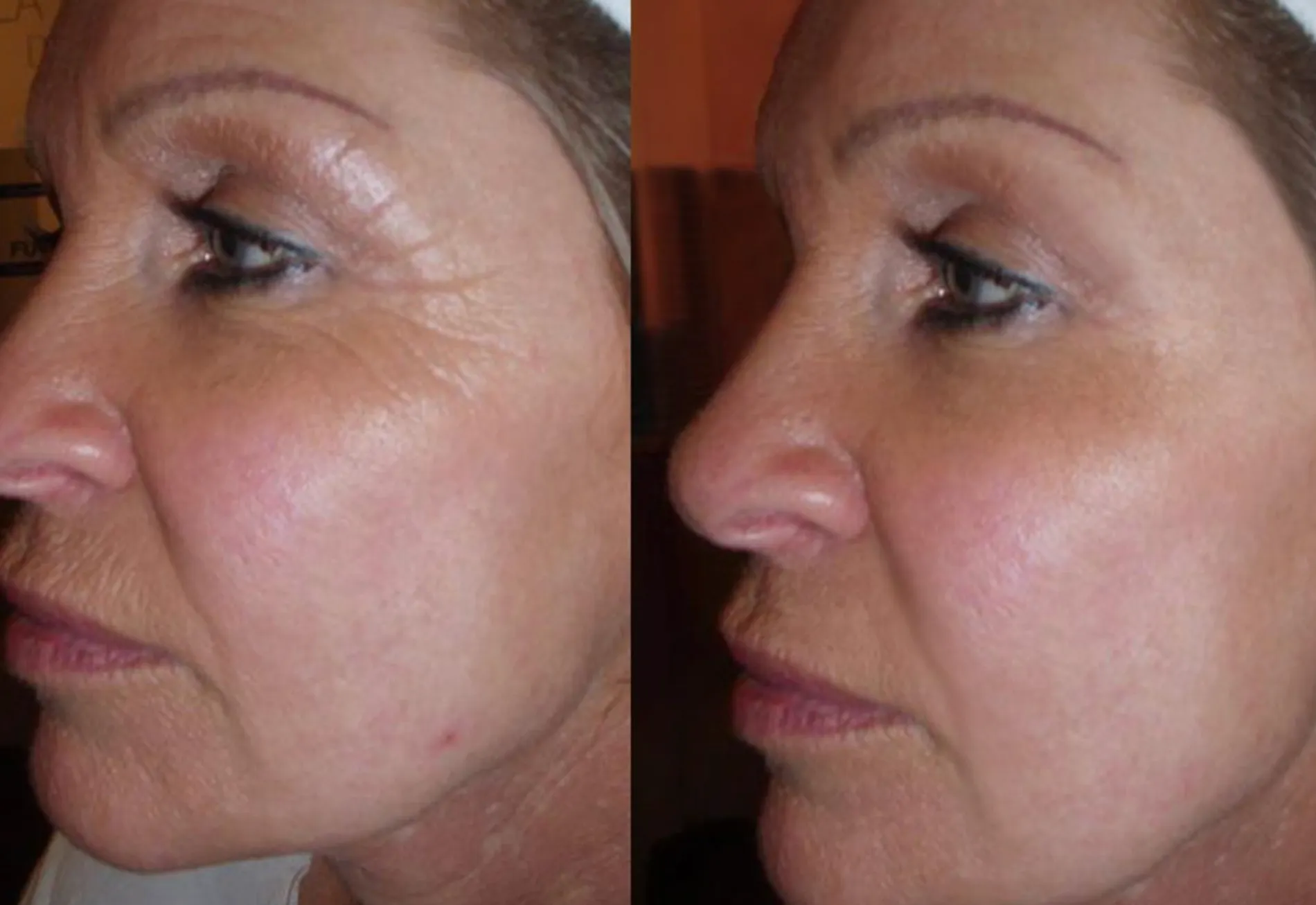 Renual Medspa cryotouch before and after