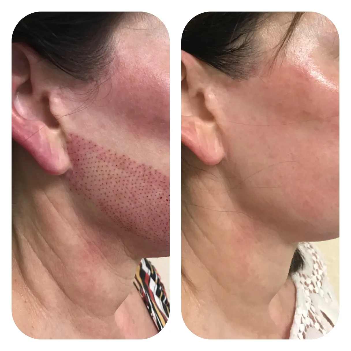 Renual Medspa plasma pen before and after