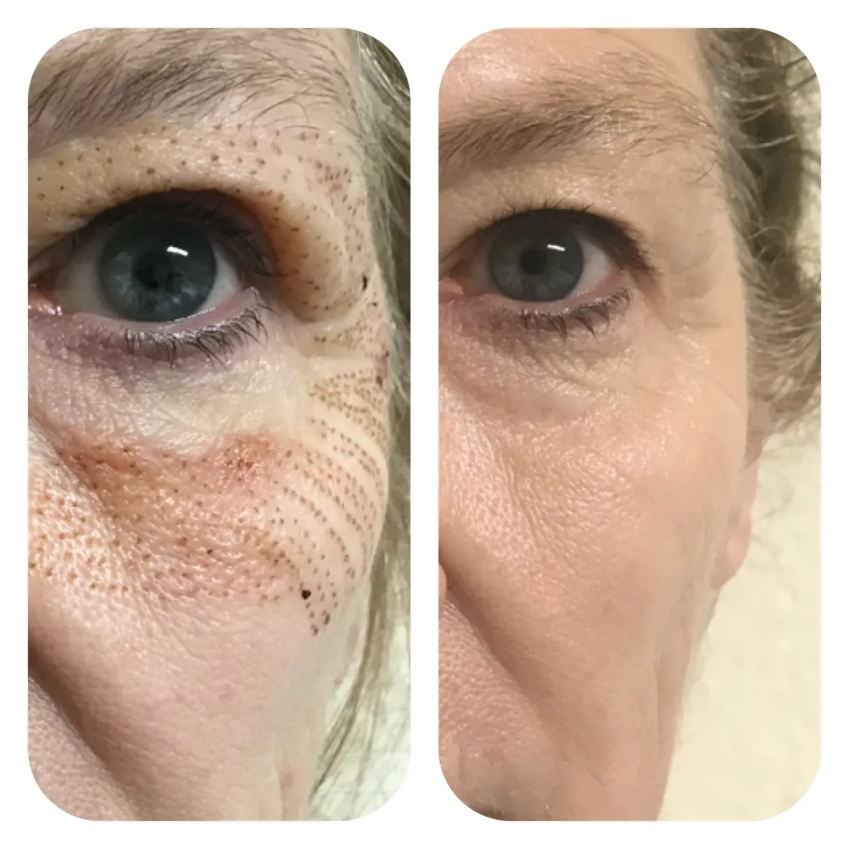 Renual Medspa plasma pen before and after