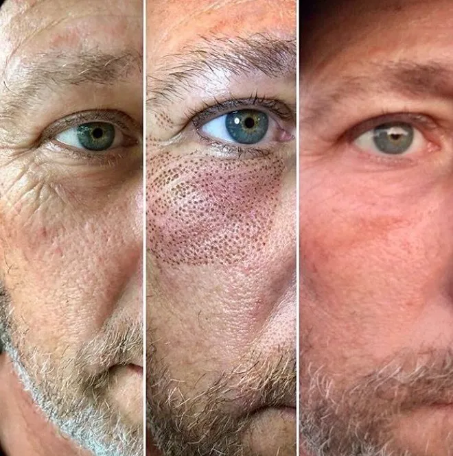 Renual Medspa plasma pen before and after