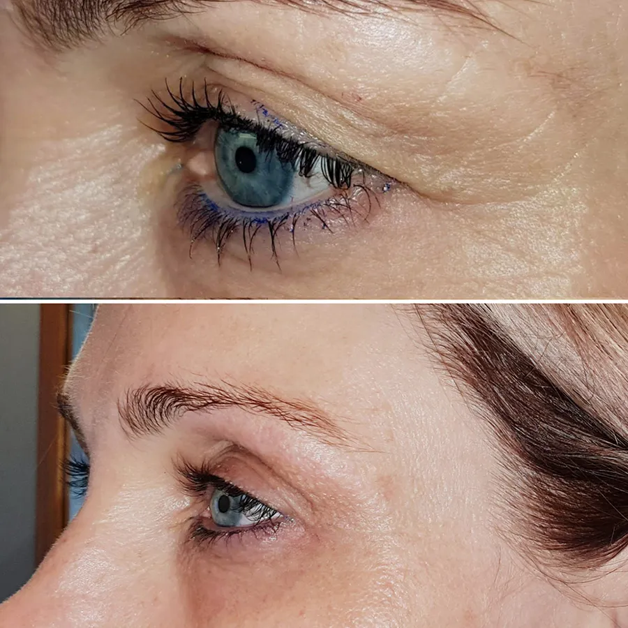Renual Medspa plasma pen before and after